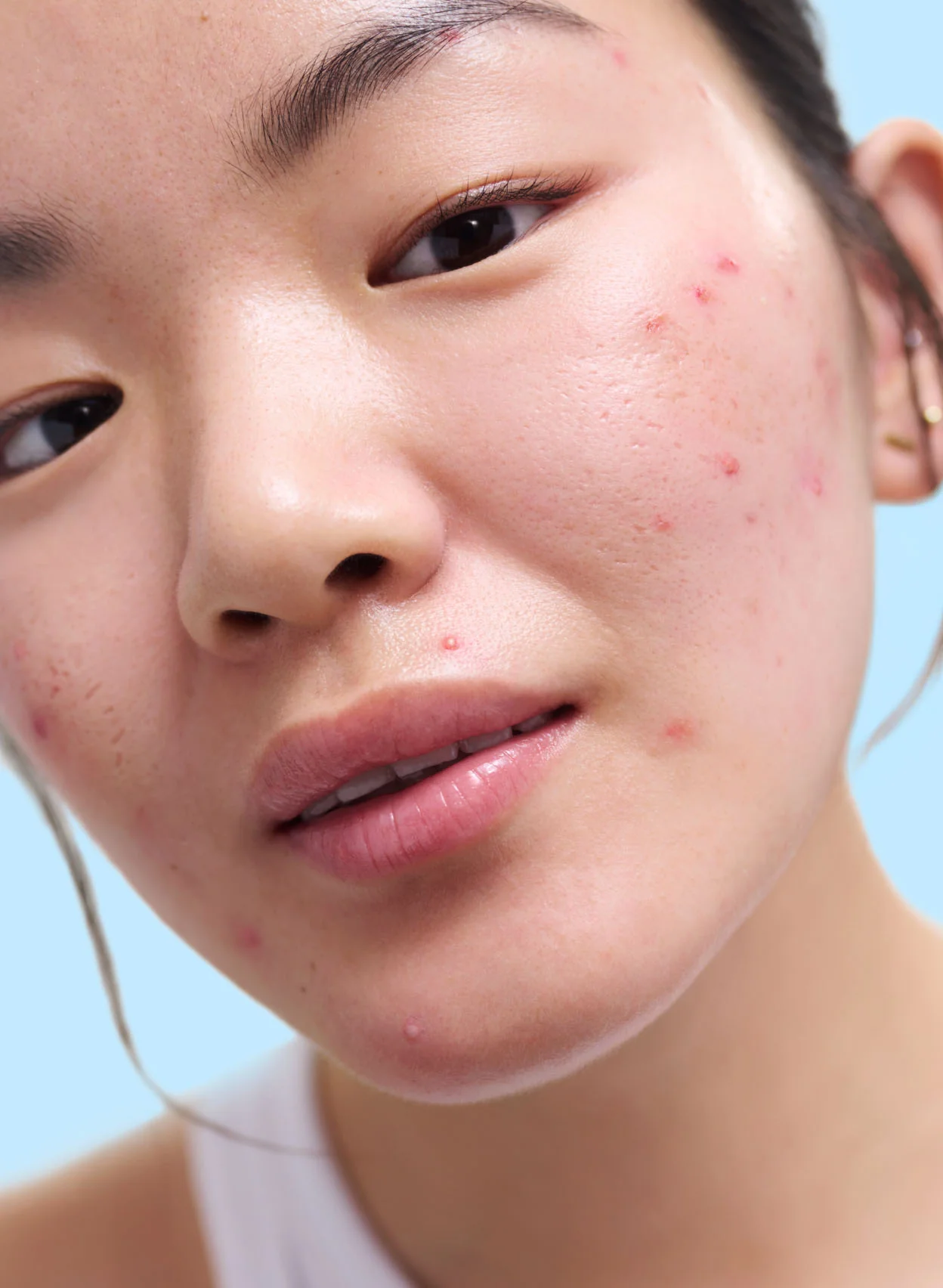 Acne Exfoliating Toner - Image 3