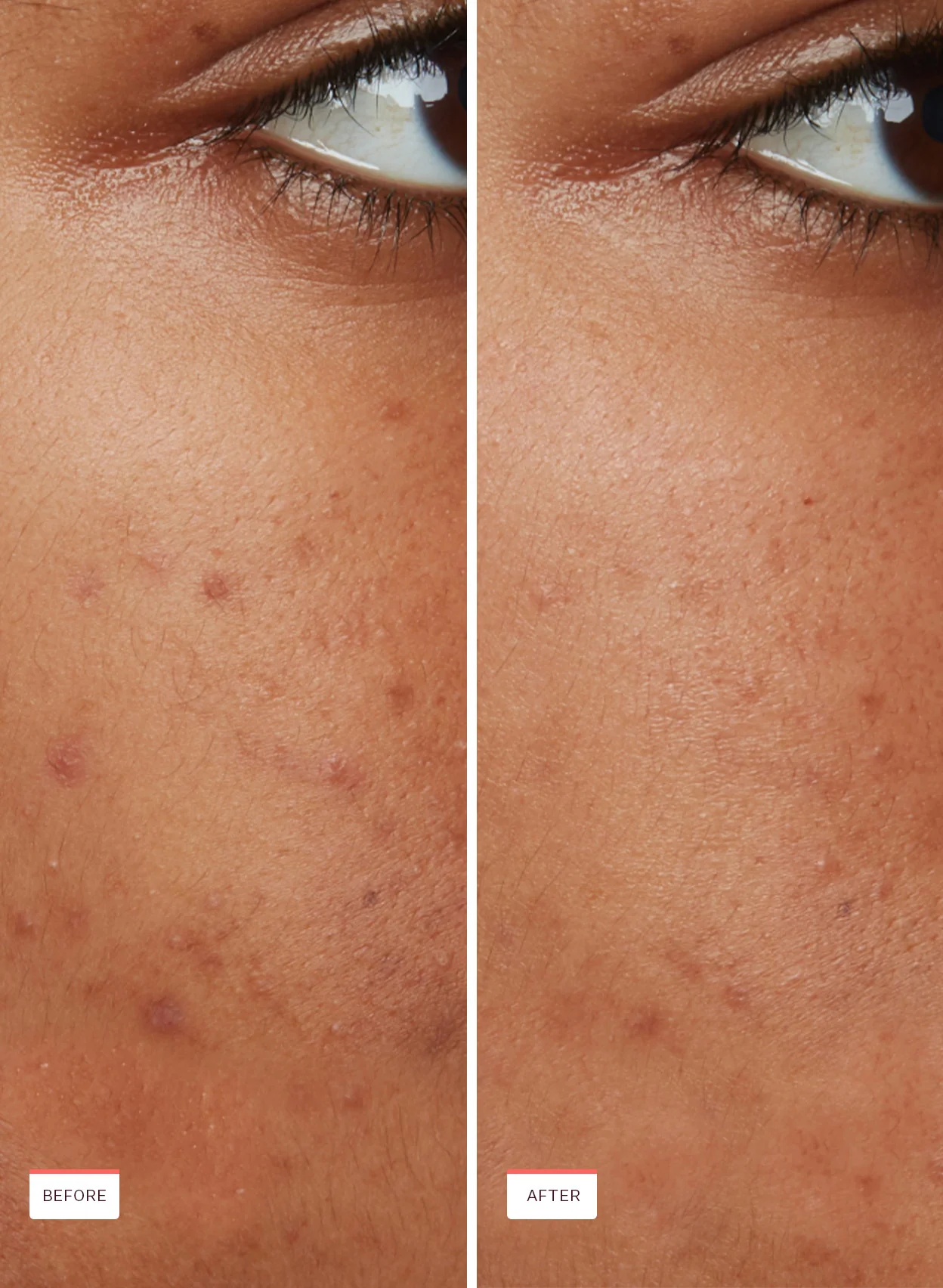 Acne Oil-Free Moisturizer - Image 7