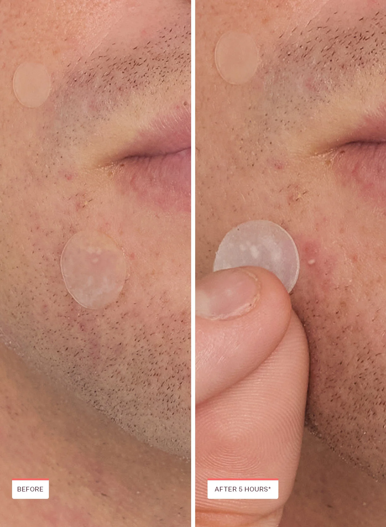 Pimple & Pore Patch Pack - Image 6