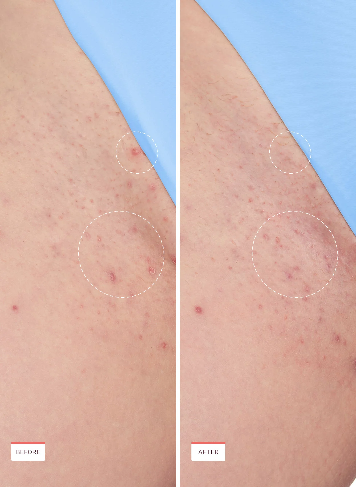 Smoothing Solution Ingrown Hair Treatment Bundle - Image 8